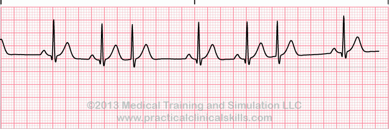 Trigeminal Premature Ventricular Contractions