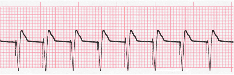 Pacemaker single chamber ventricular