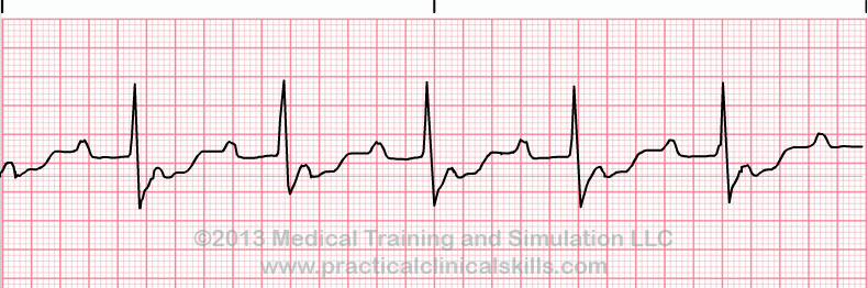 Second Degree Heart Block 2 to 1 Conduction Block