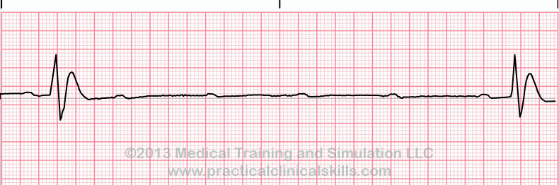 Sinus Arrest